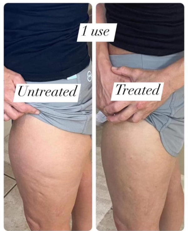 RenuSpa - aka cellulite zapper - receive firming cream as gift