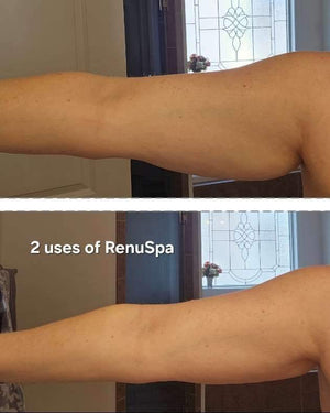 RenuSpa - aka cellulite zapper - receive firming cream as gift with purchase - $60 value